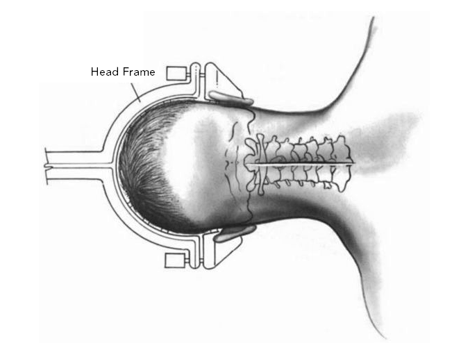 head frame instrument