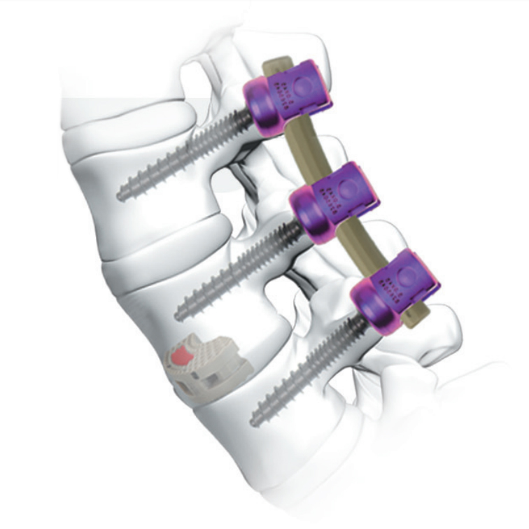 Peek Rod Spinal Fusion System