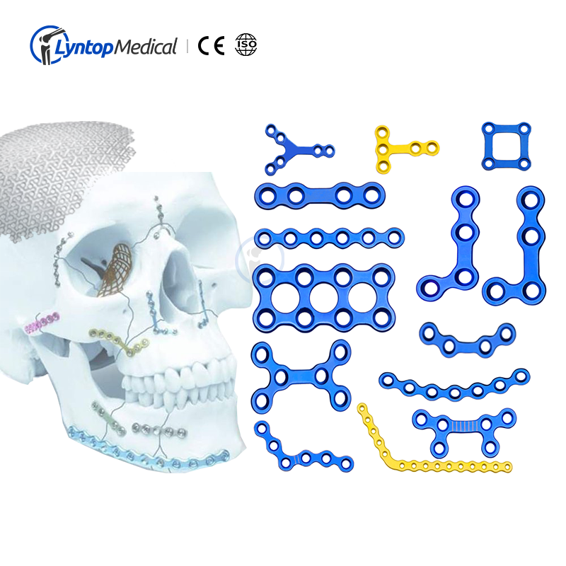 Craniomaxillofacial titanium plating system