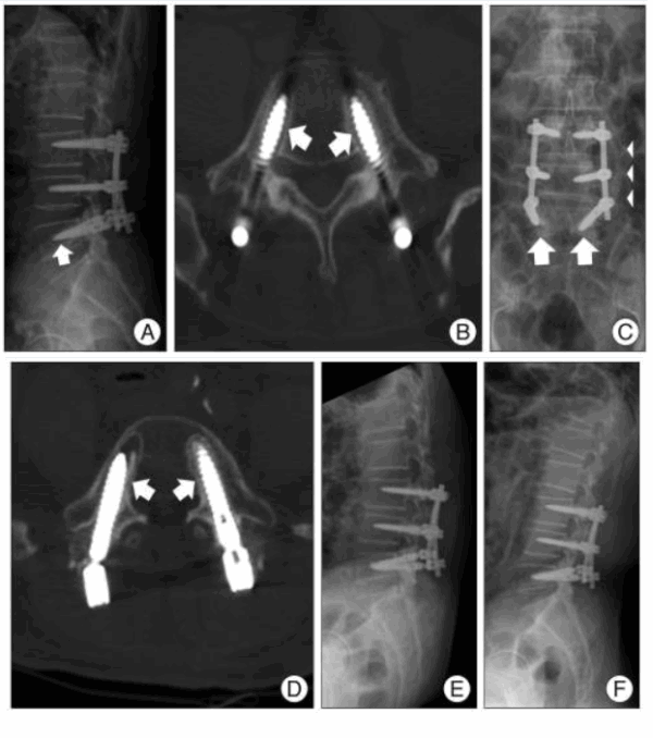 Pedile Treatment for Loose Pedicle Screws: Surgical and Non-Surgical Strategies