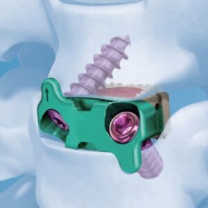 cervical peek cage with screw