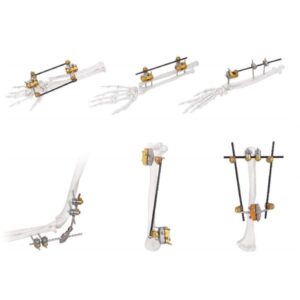 Upper Limb Combinational External Fixation System