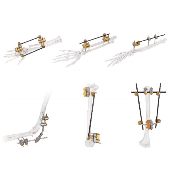 Upper Limb Combinational External Fixation System