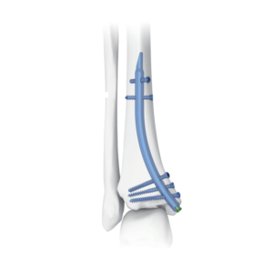 Haste Tibial Distal