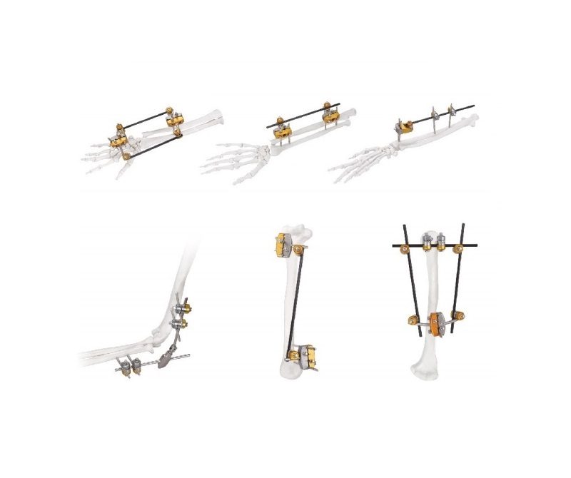 External Fixation System 800x670 (2)